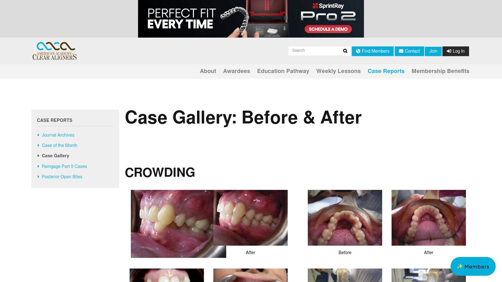 American Academy of Clear Aligners (AACA) — Case Gallery