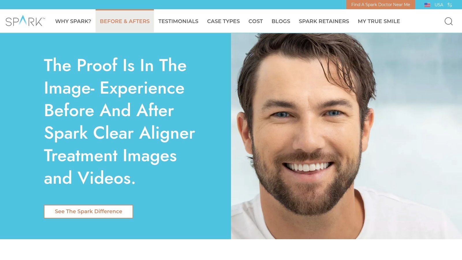 Spark Aligners — Before & After Gallery