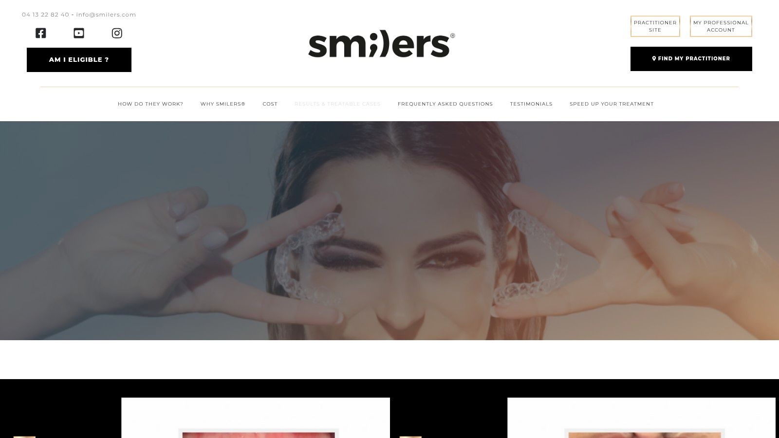 Smilers — Results & Treatable Cases