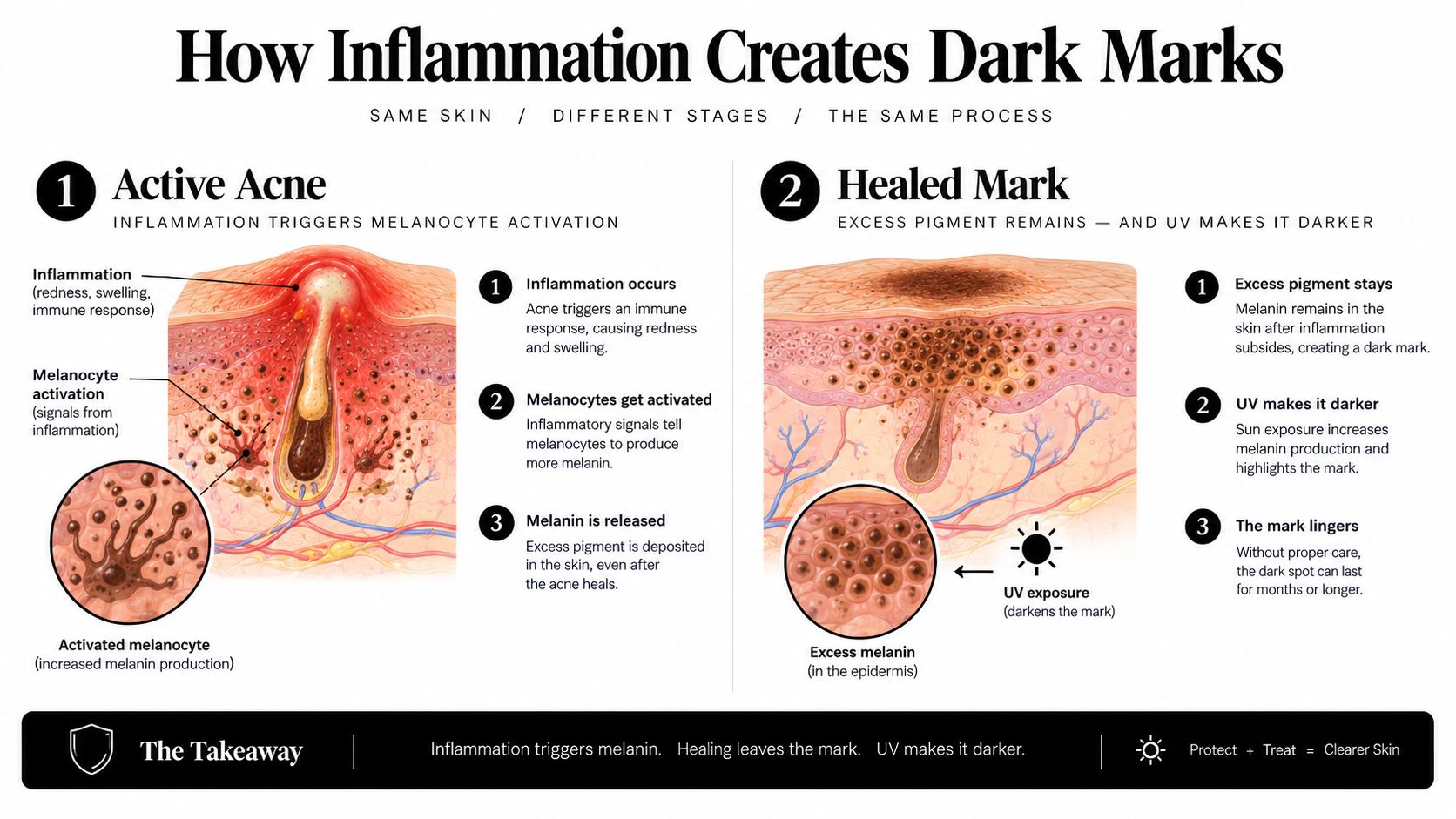 An infographic illustrating how acne inflammation leads to post-inflammatory hyperpigmentation and dark marks on the skin.