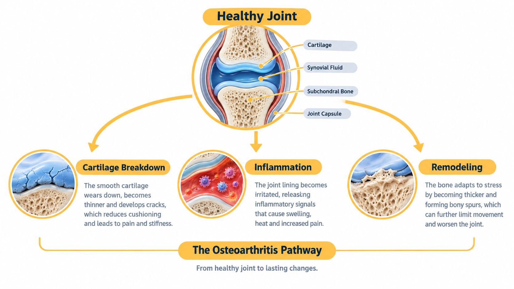 A diagram illustrating the progression of osteoarthritis from a healthy joint to cartilage breakdown, inflammation, and bone remodeling.