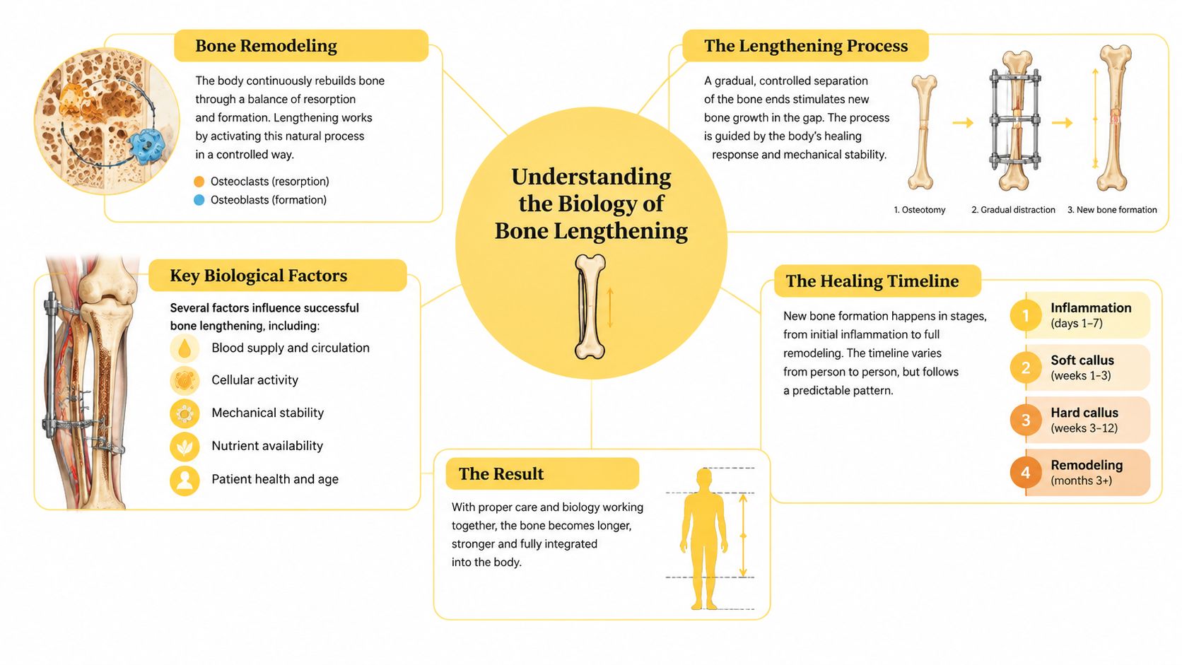 A diagram explaining the biological process of bone lengthening, including remodeling, stages, and factors for healing.