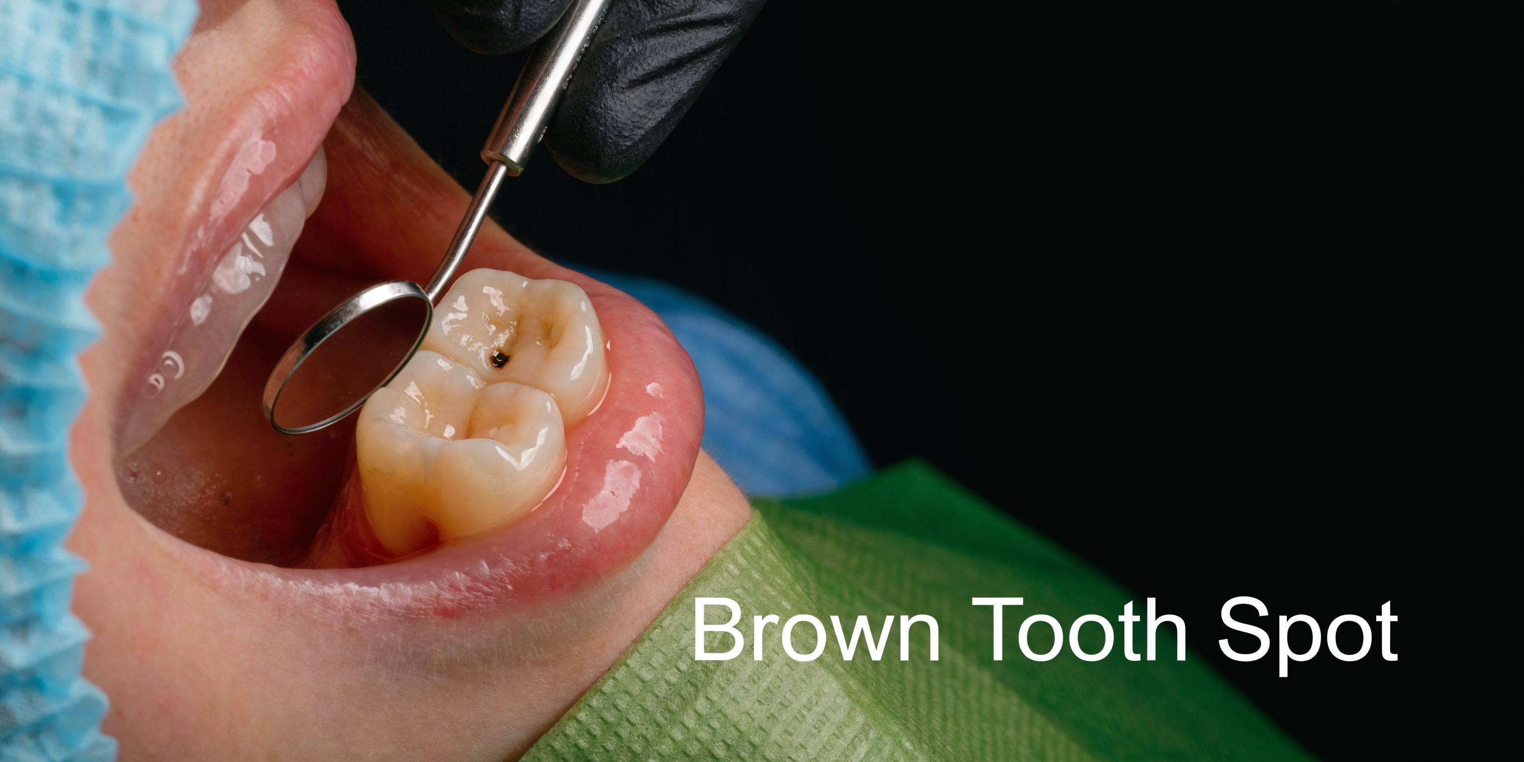 A dentist examines a patient's molar with a small dental mirror, revealing a distinct brown tooth decay spot.