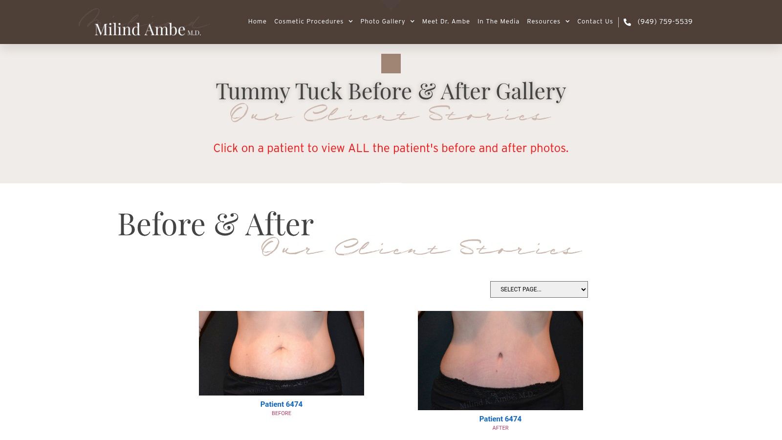 Newport Beach Plastic Surgery – Tummy Tuck Before & After (Milind K. Ambe, MD)