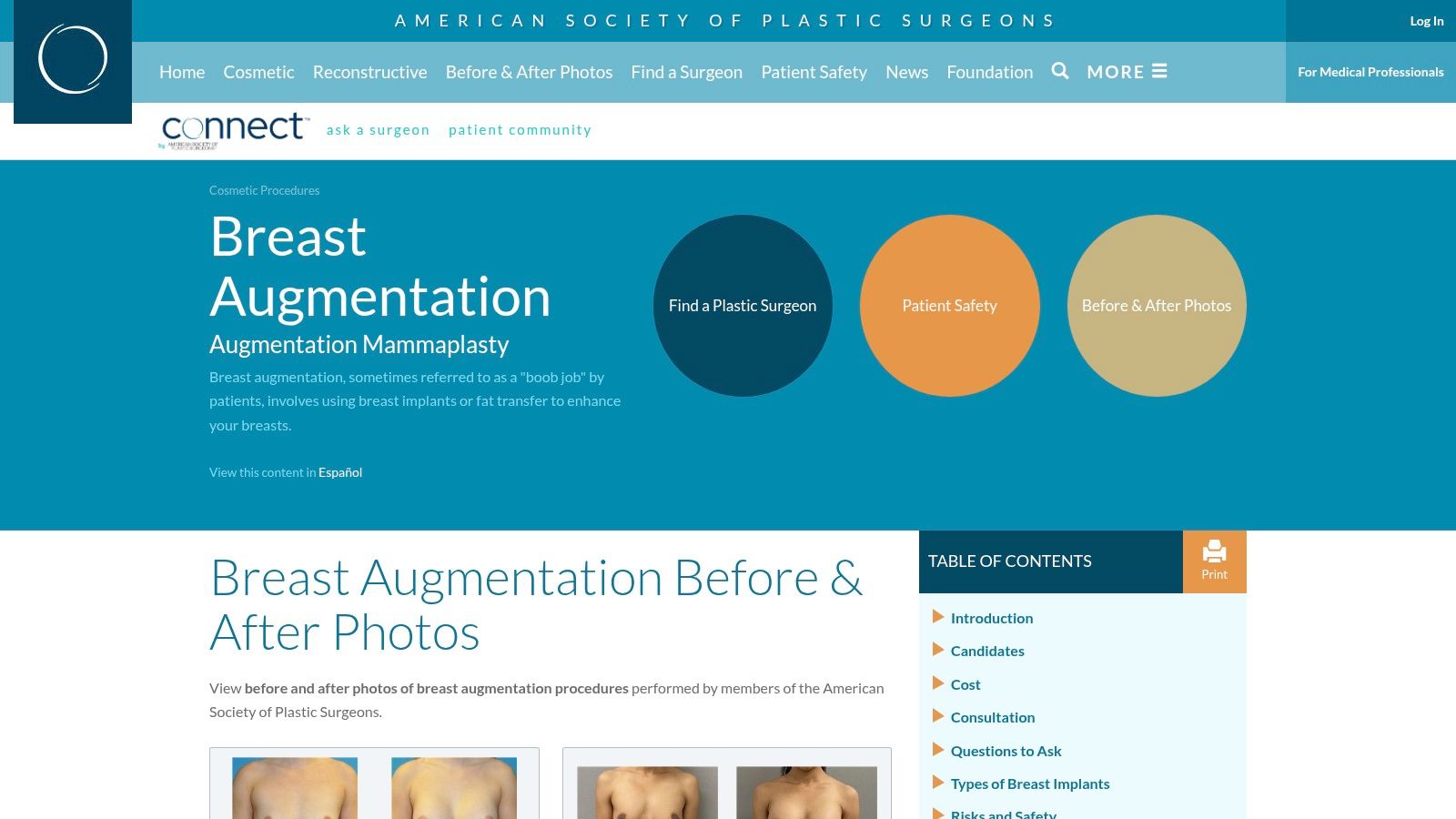 American Society of Plastic Surgeons (ASPS) – Breast Augmentation Photo Gallery