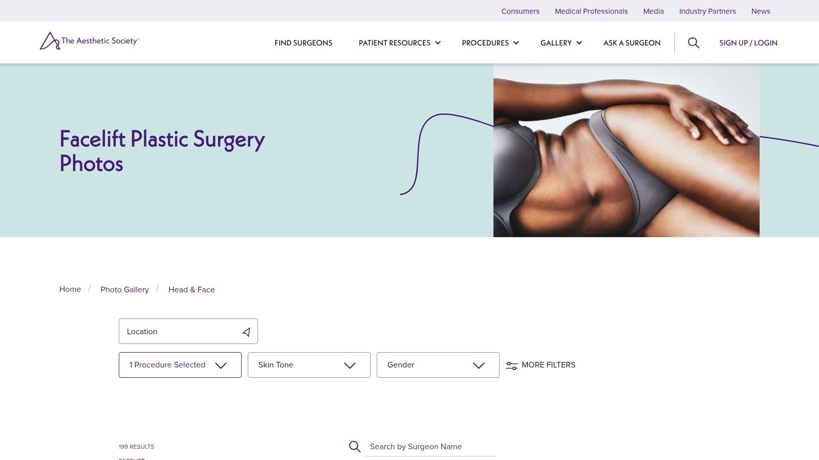 The Aesthetic Society – Facelift Before & After Photo Gallery