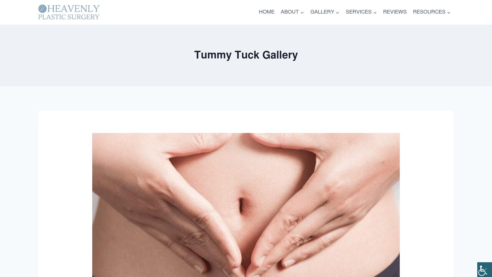 Heavenly Plastic Surgery – Tummy Tuck Gallery (Orange County/Fullerton)