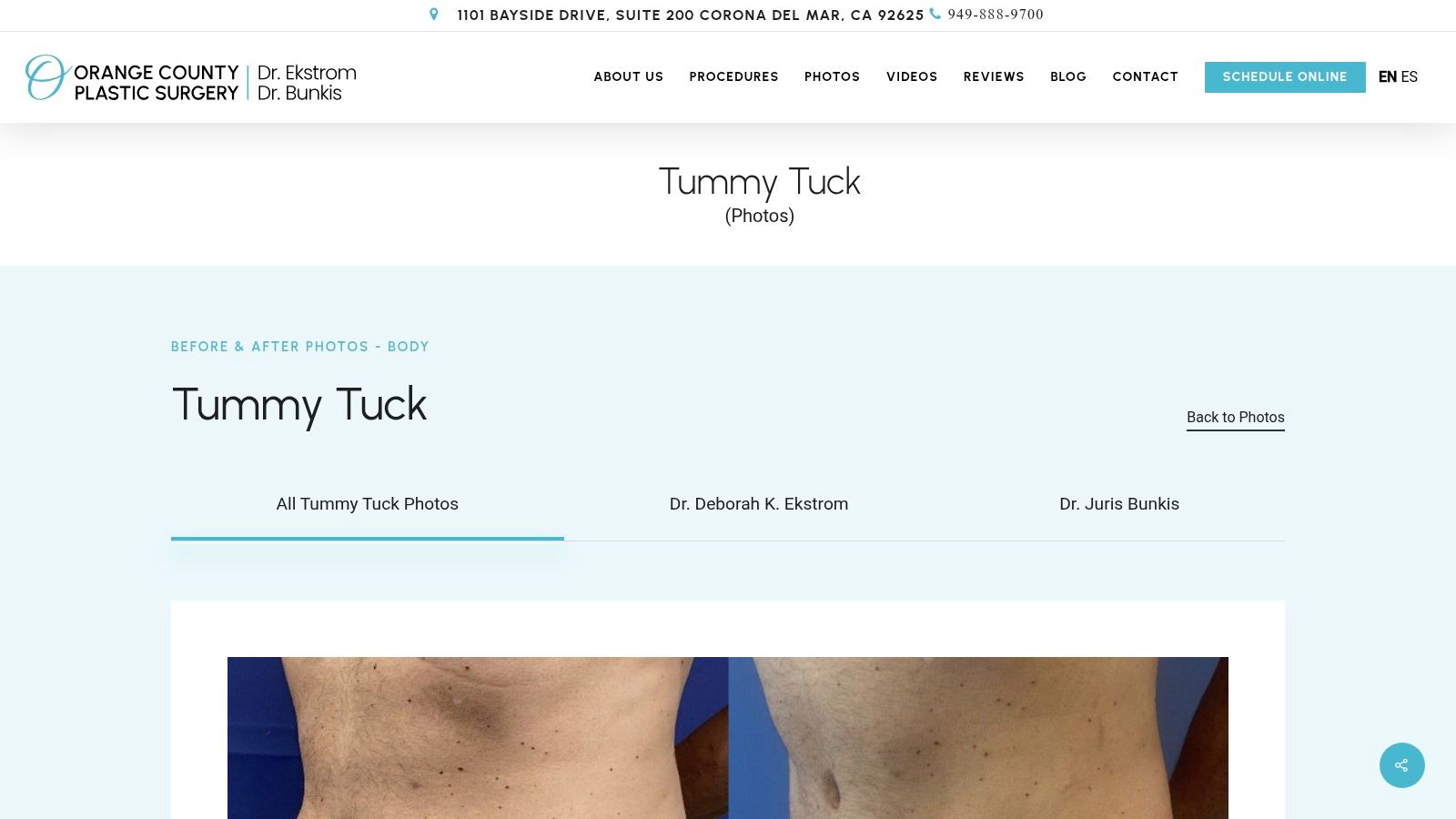 Orange County Plastic Surgery – Tummy Tuck Gallery (Newport Beach/OC)