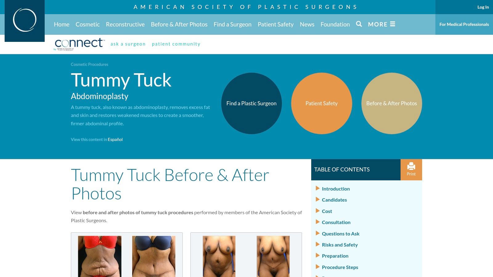 American Society of Plastic Surgeons (ASPS) – Tummy Tuck Photo Gallery