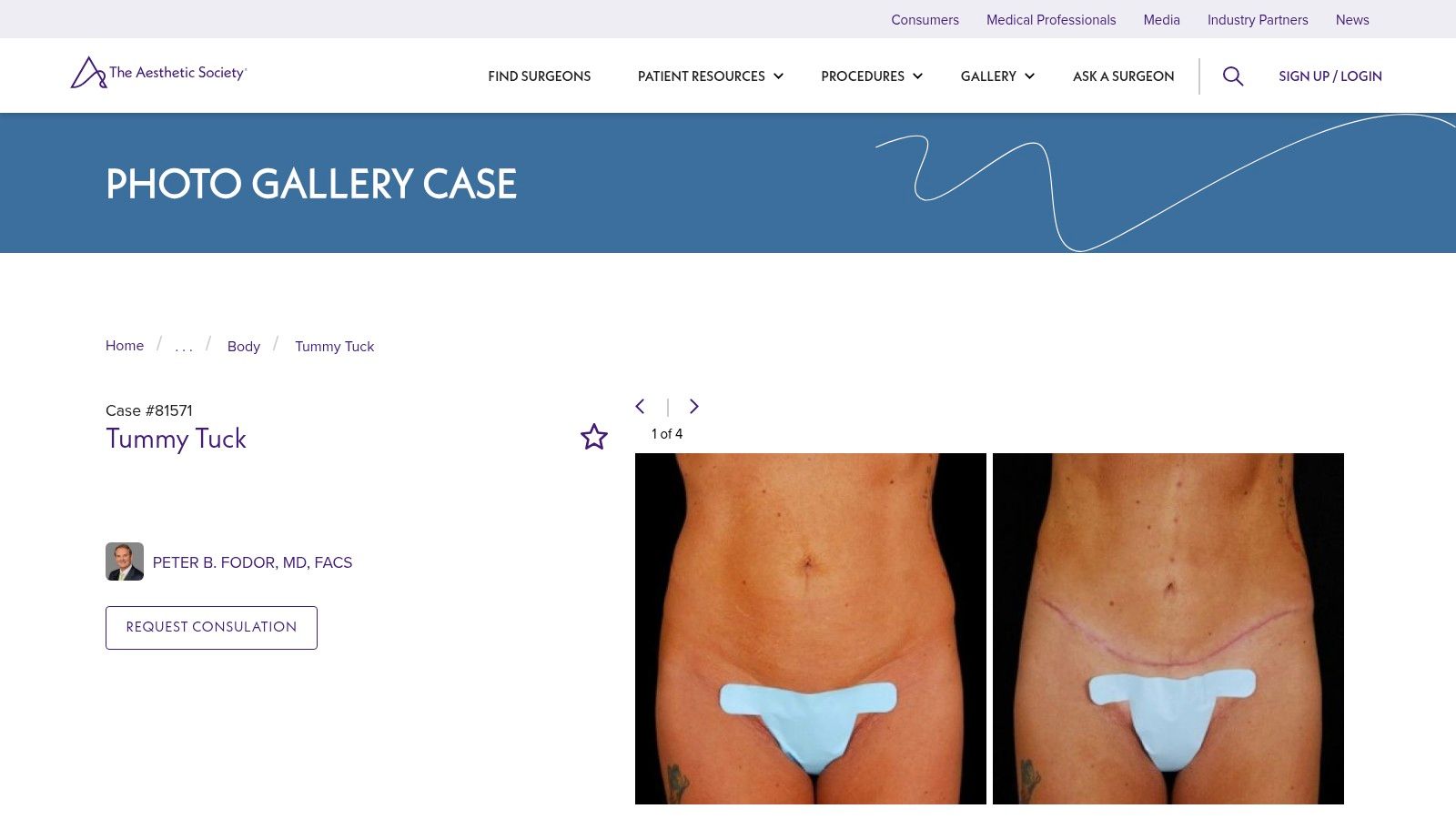 The Aesthetic Society – Tummy Tuck Photo Gallery