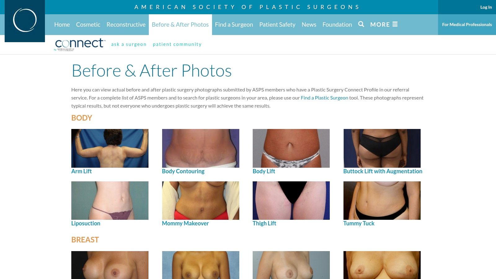 American Society of Plastic Surgeons (ASPS) – Facelift Photo Gallery