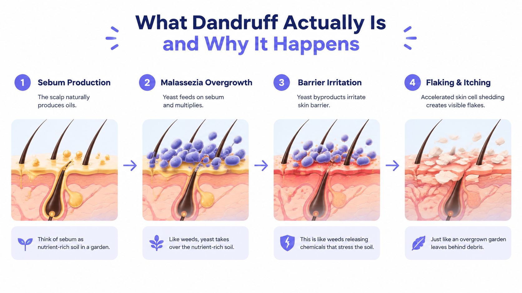 An infographic illustrating the four-step biological process of how dandruff develops on the human scalp.