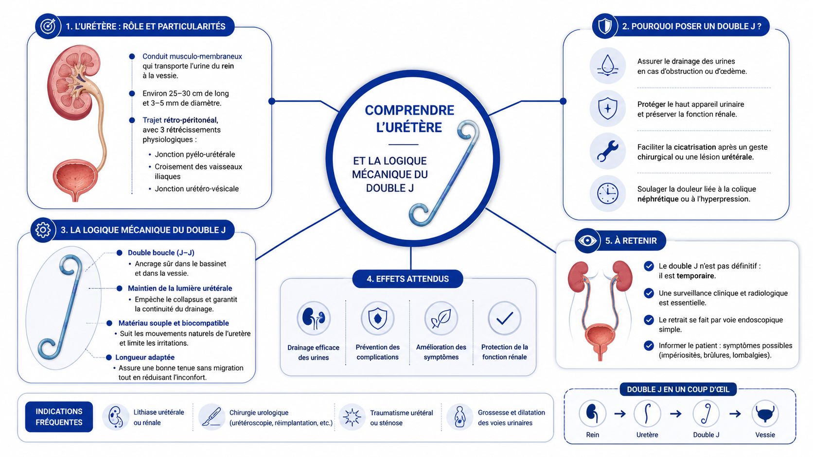 Infographie explicative sur le rôle, l'utilisation et le fonctionnement mécanique d'une sonde urétérale double J.