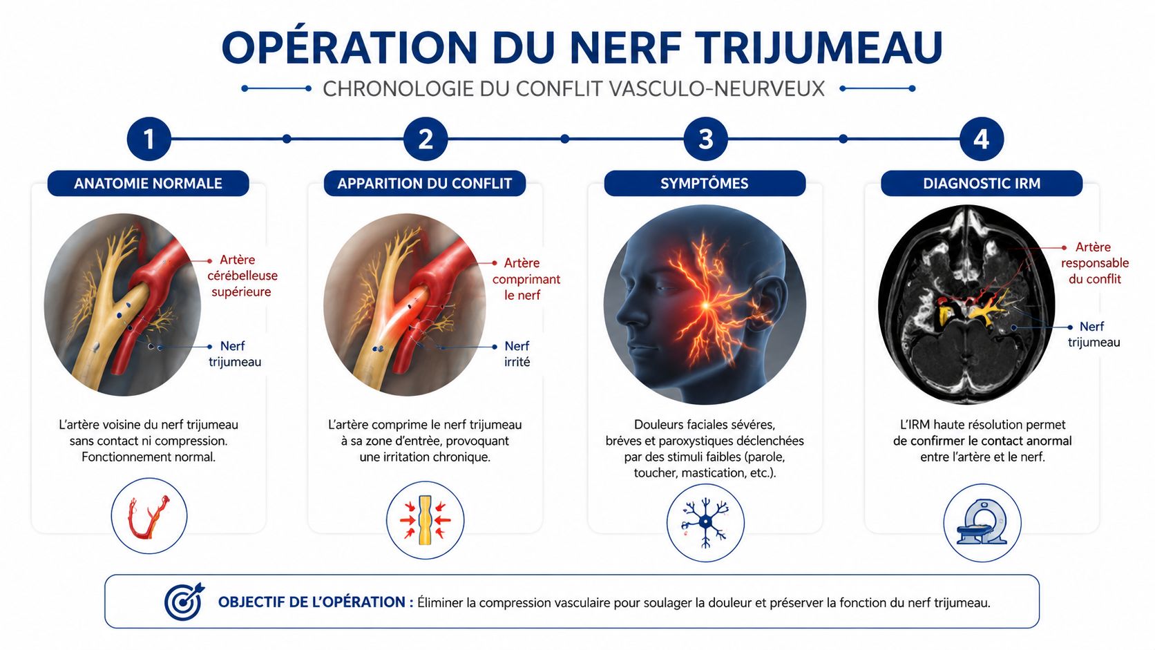 Infographie illustrant les étapes chronologiques du conflit vasculo-nerveux responsable de la névralgie du nerf trijumeau.