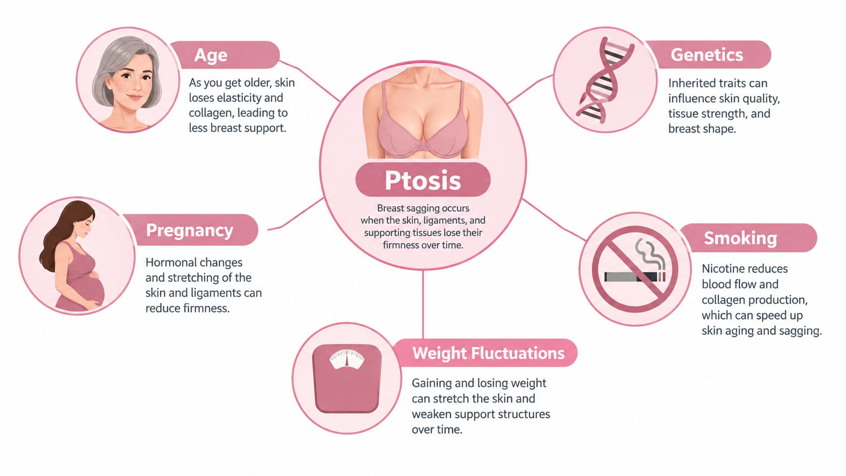 An infographic showing the various causes of breast ptosis, including aging, genetics, pregnancy, weight fluctuations, and smoking.