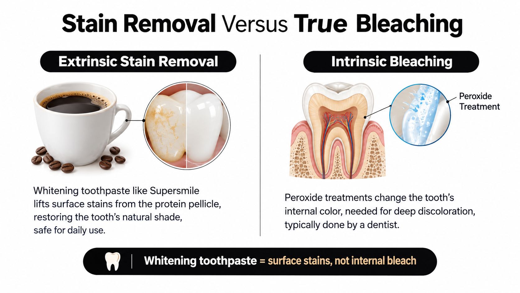 A dental infographic comparing extrinsic surface stain removal using toothpaste and intrinsic peroxide teeth bleaching treatments.