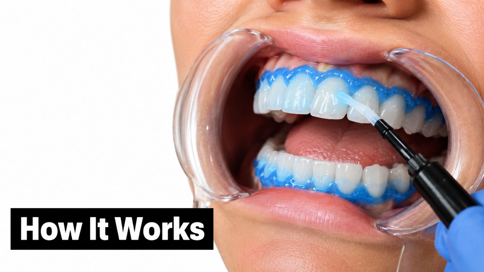 A professional dentist applies blue teeth whitening gel to a patient using a small brush tool.