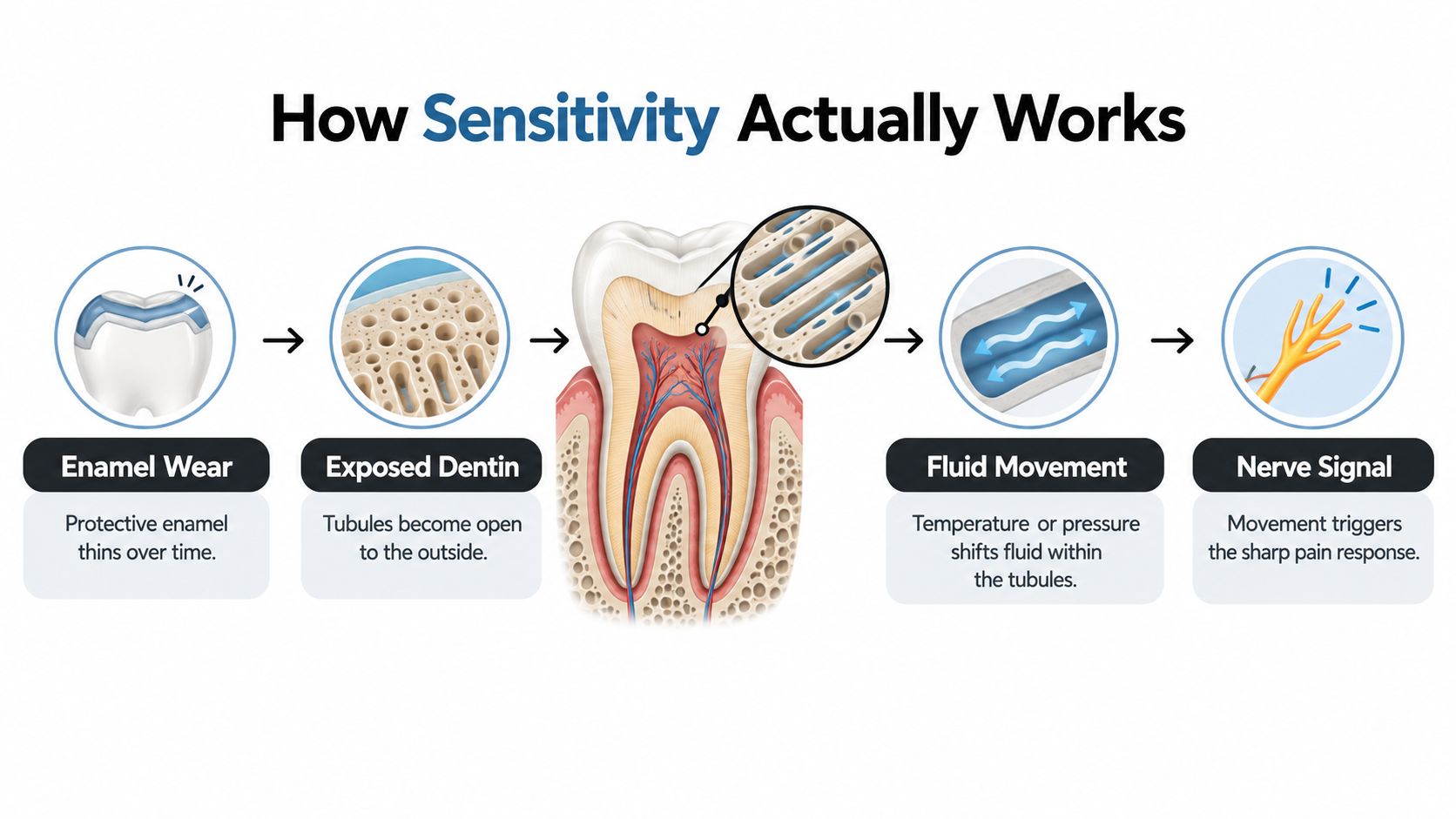 A diagram illustrating the biological process of tooth sensitivity starting from enamel wear to nerve pain signals.