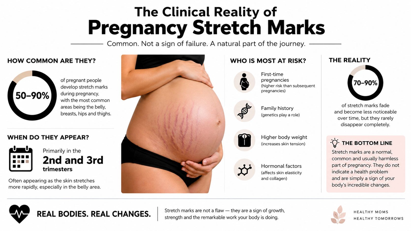 An infographic detailing the clinical facts about pregnancy stretch marks, explaining their prevalence, causes, and fading nature.