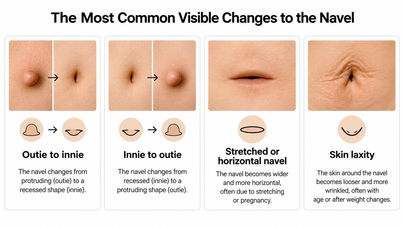 A diagram illustrating common visual changes to the navel, including outie to innie, innie to outie, stretched, and skin laxity.
