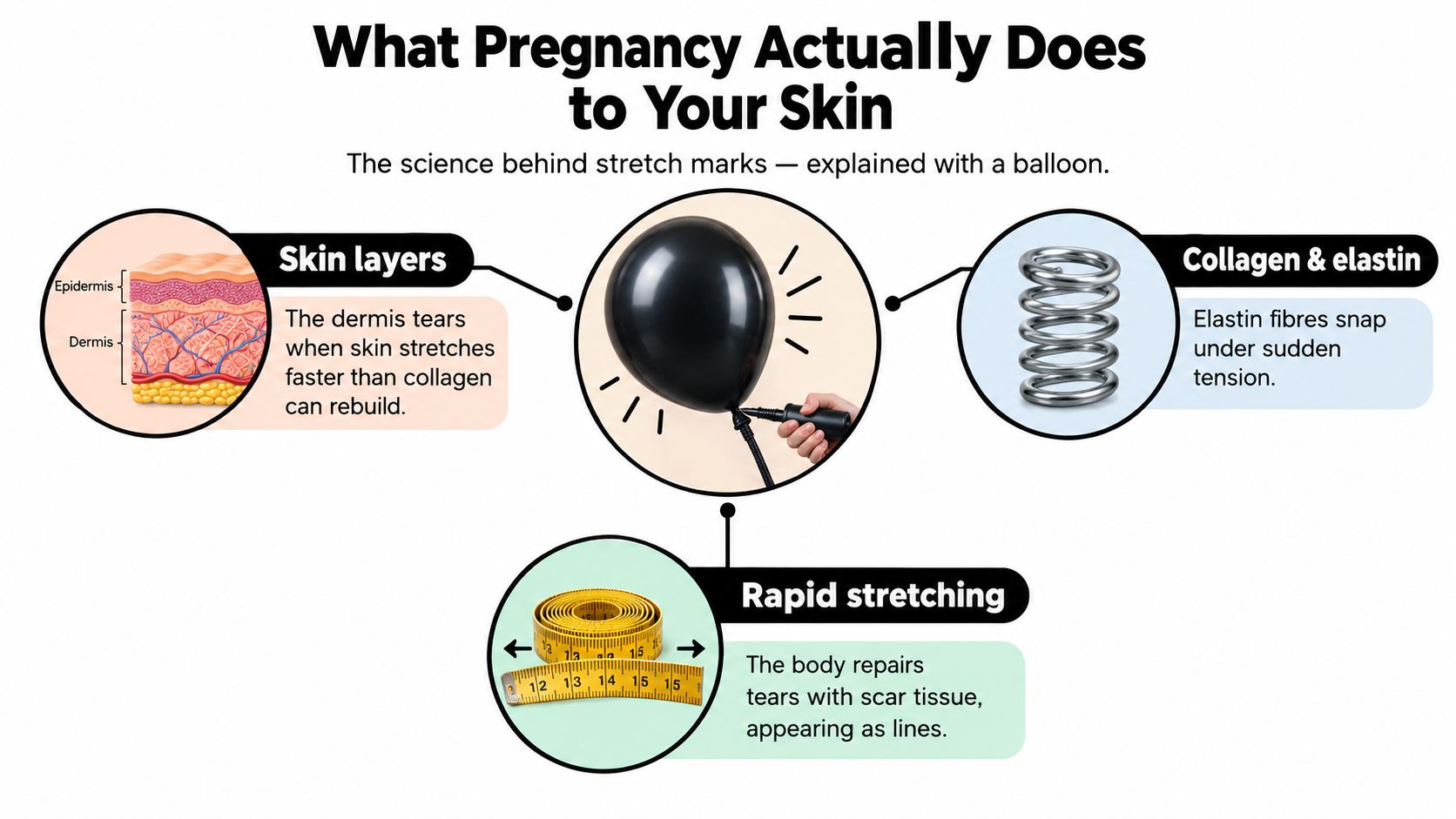 An infographic explaining how skin stretches during pregnancy to form stretch marks using visual analogies.