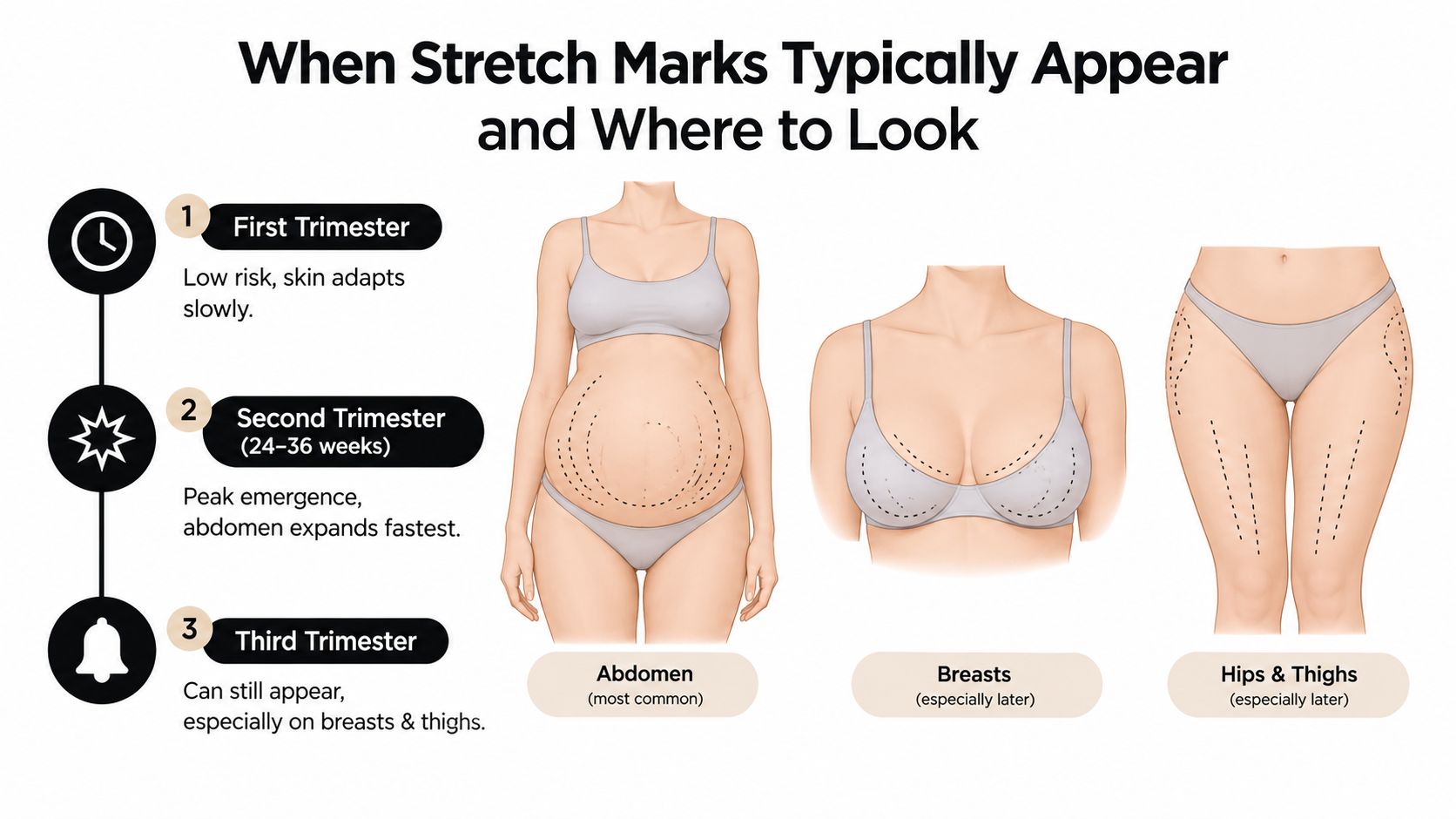 An infographic showing the stages of pregnancy and common body areas where stretch marks typically develop.