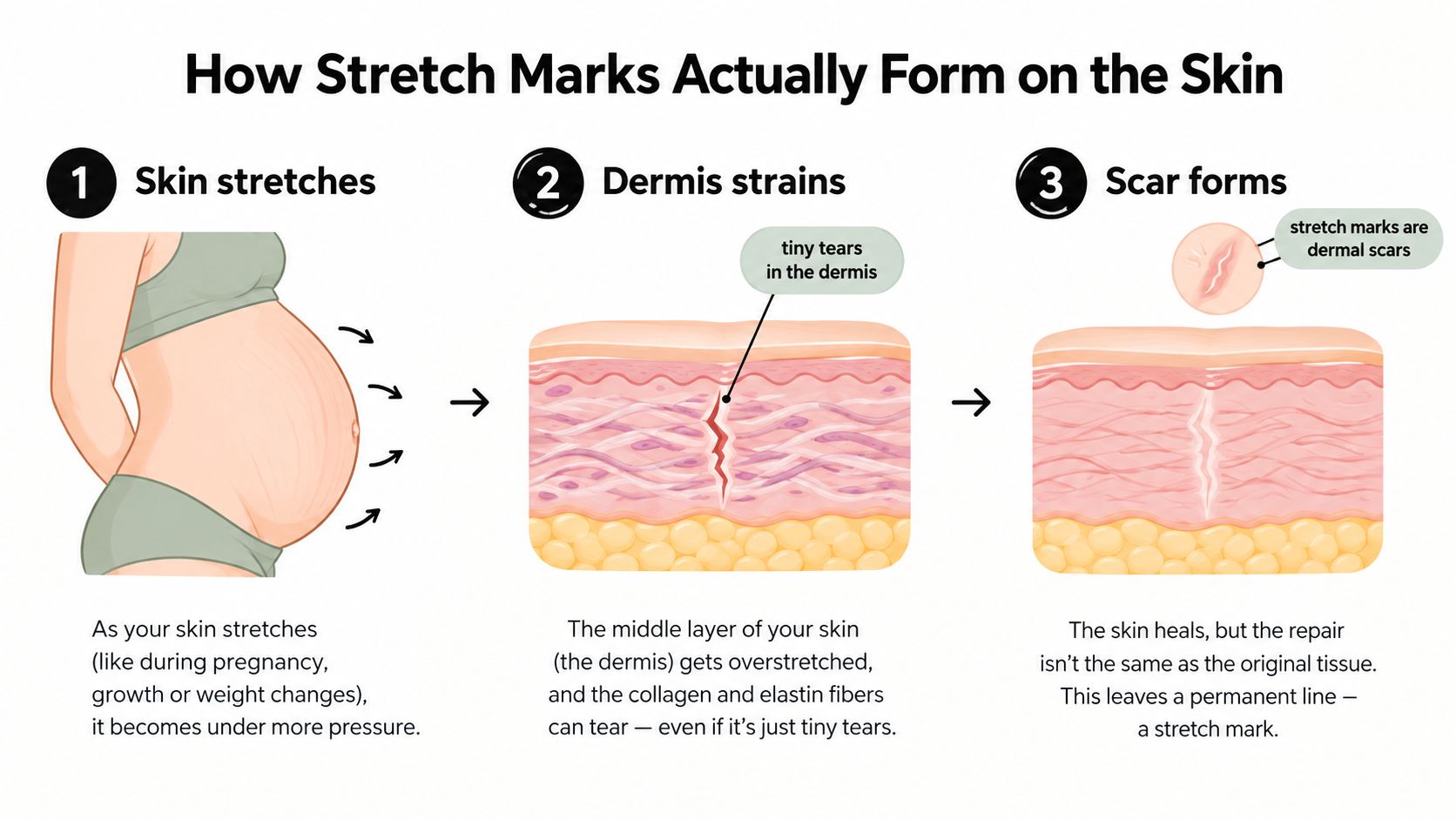 A diagram illustrating the three steps of how pregnancy stretch marks form in the skin layers.