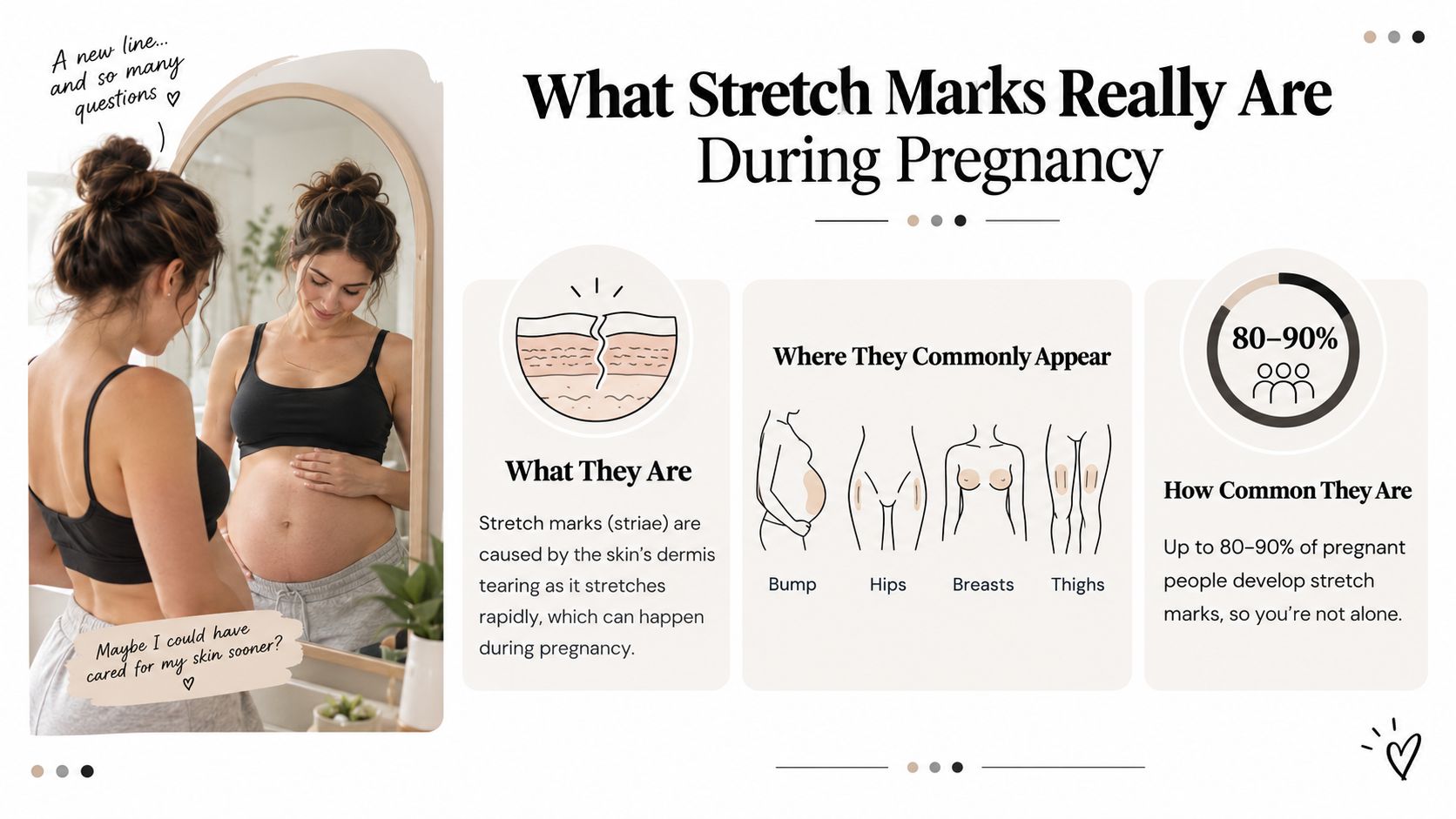 An infographic explaining how stretch marks occur, where they appear on the body, and their prevalence.
