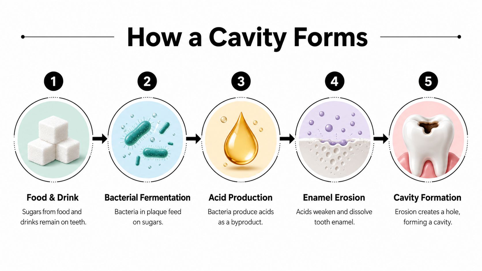 An infographic showing the five-step process of how cavities form on human teeth, from sugar consumption to decay.
