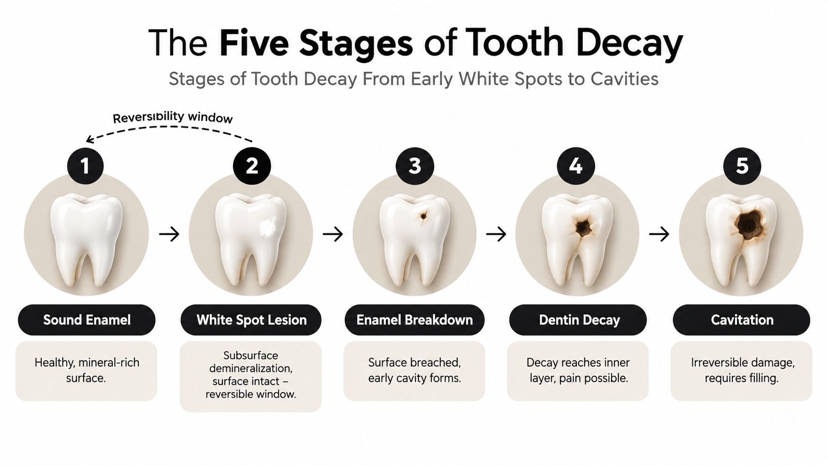 An infographic showing the five progressive stages of tooth decay, from sound enamel to irreversible cavity damage.