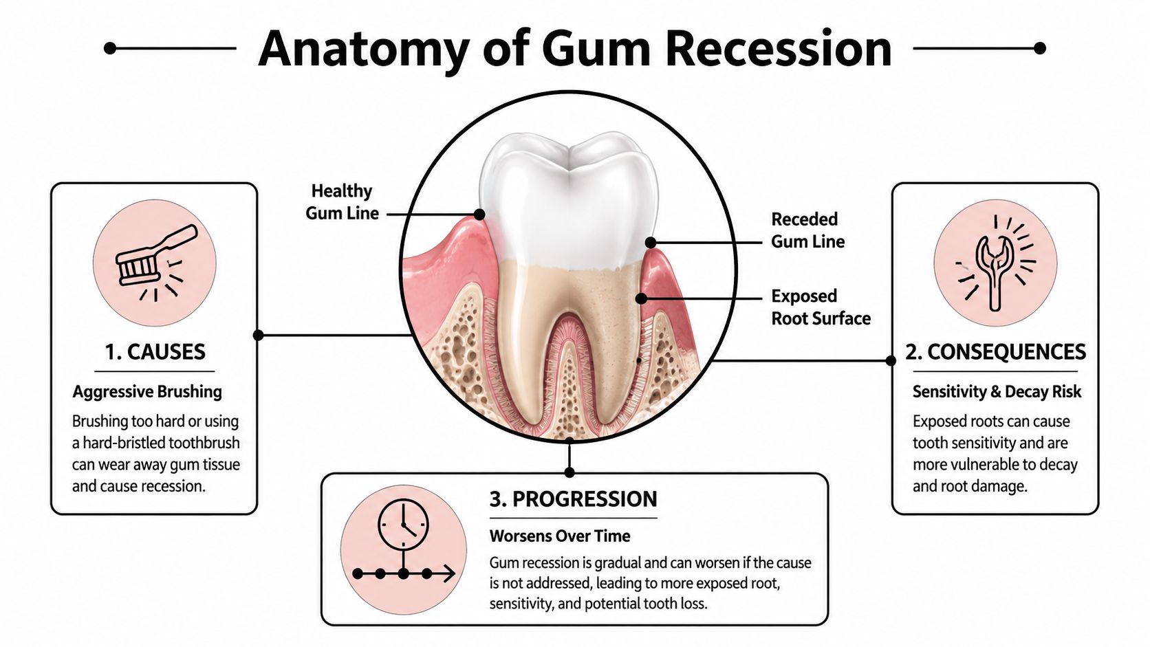 An infographic illustrating the causes, consequences, and progression of gum recession around a human tooth.