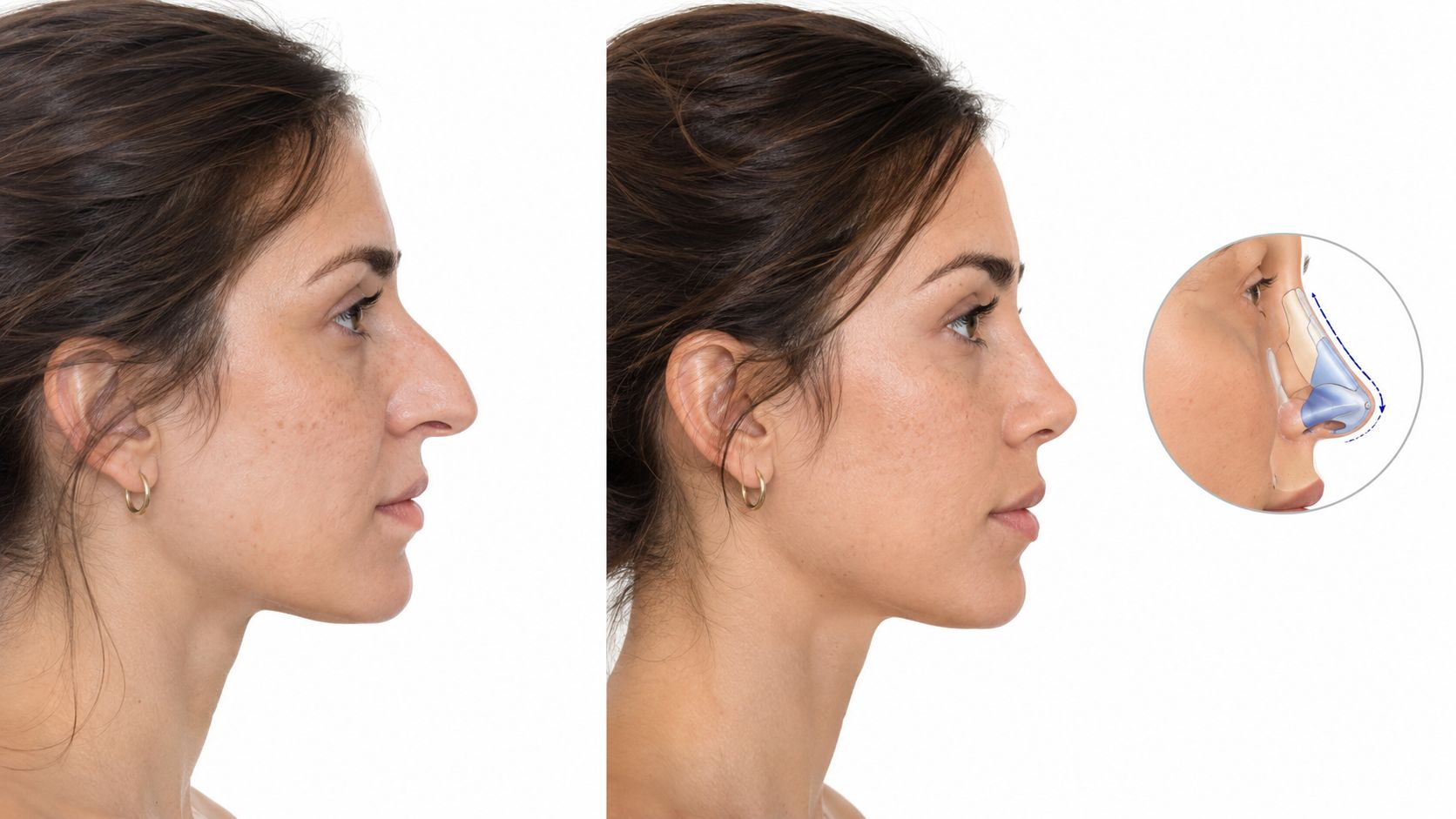 Comparativa de perfil femenino mostrando el antes y después de un procedimiento estético de nariz mediante rinomodelación.