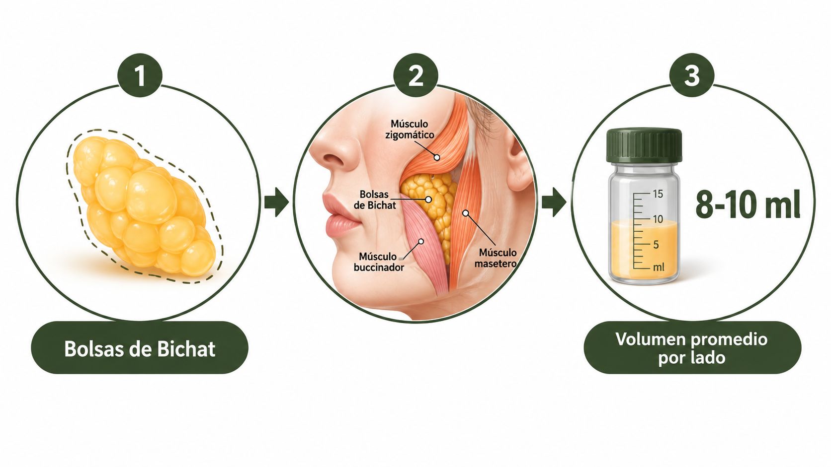 Diagrama médico que ilustra el proceso de bichectomía, mostrando la grasa y su ubicación anatómica extraída.