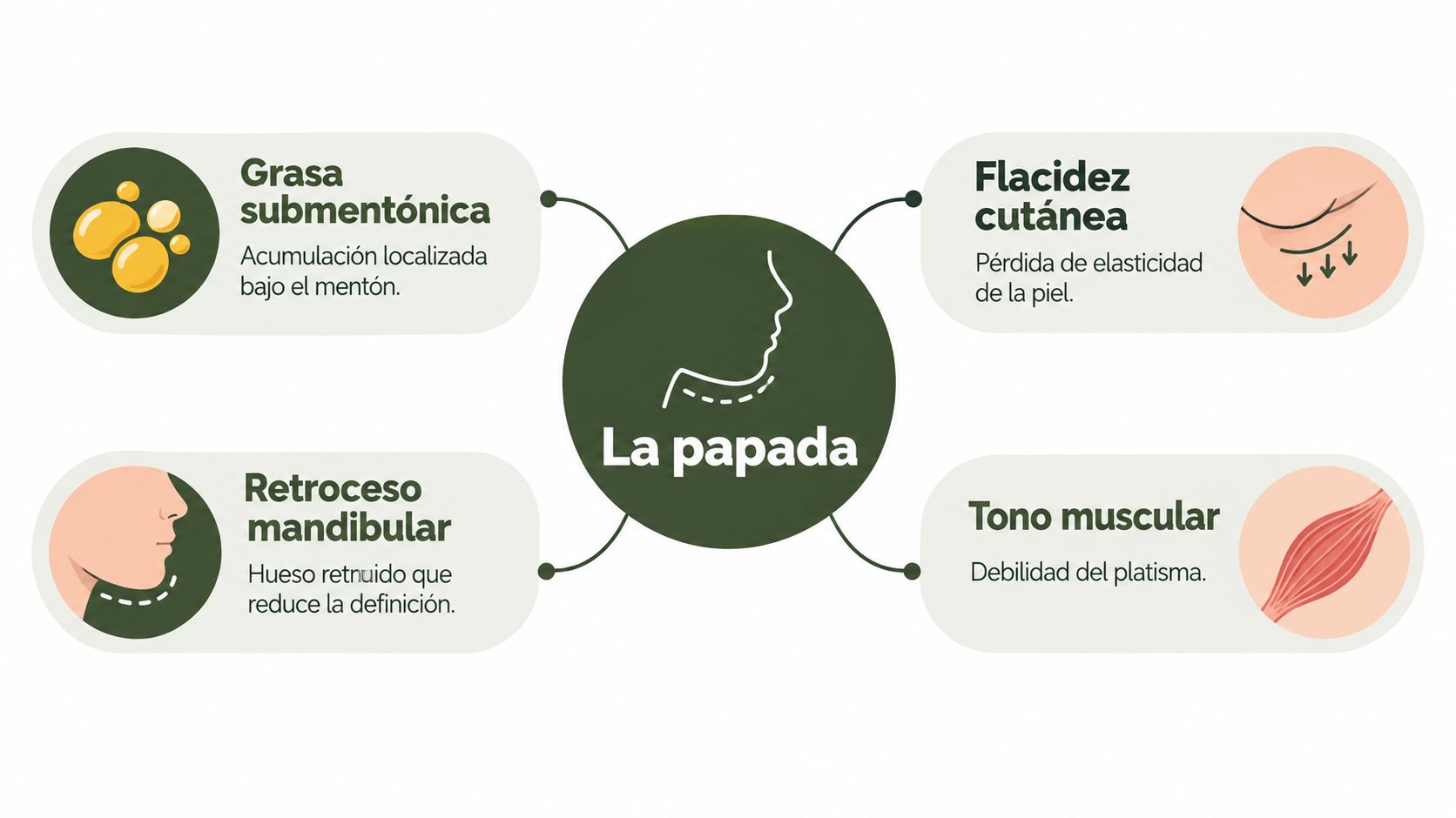 Infografía que muestra las cuatro causas principales de la aparición de la papada en el rostro humano.