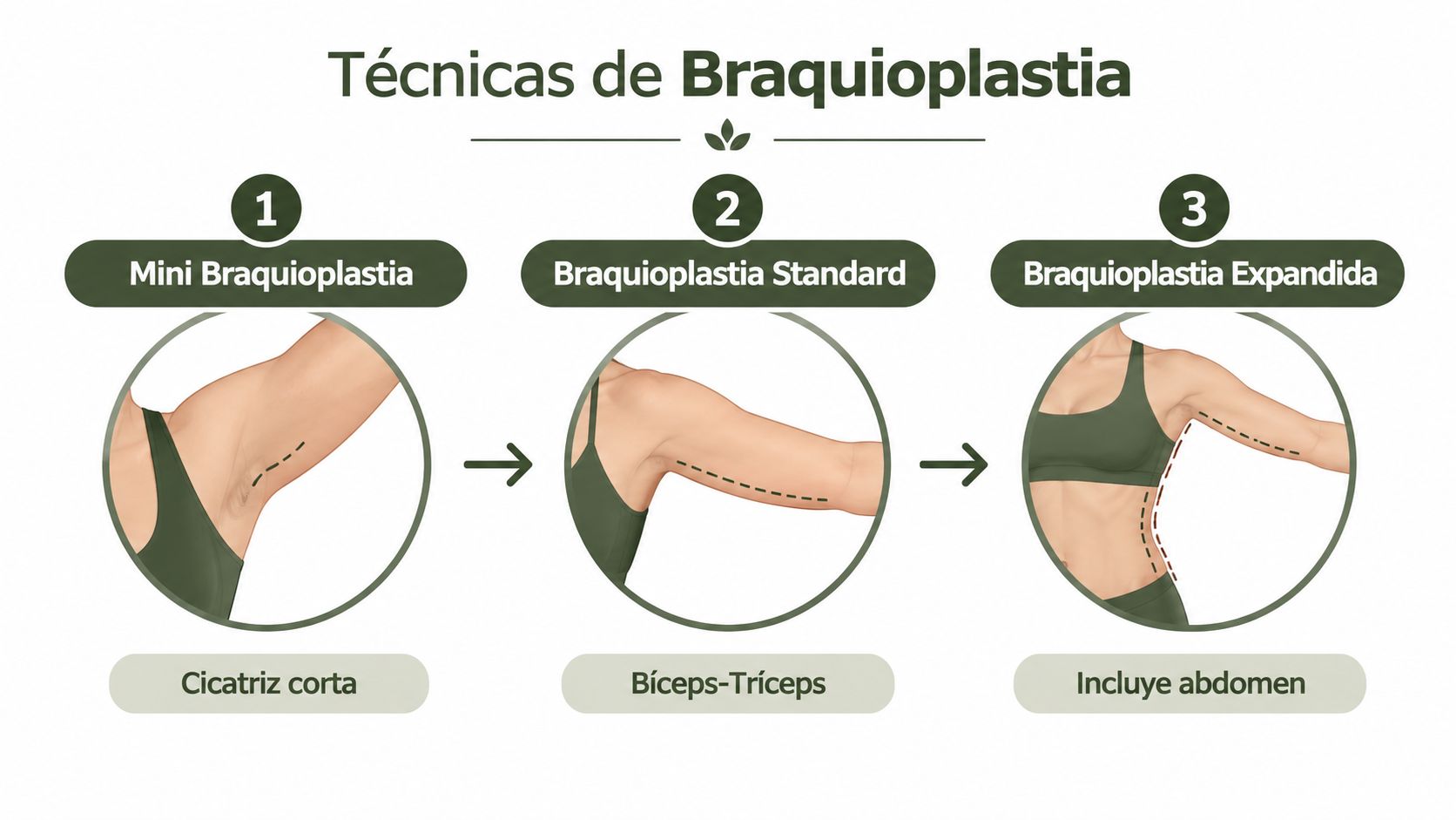 Infografía que ilustra las tres técnicas principales de cirugía de lifting de brazos o braquioplastia