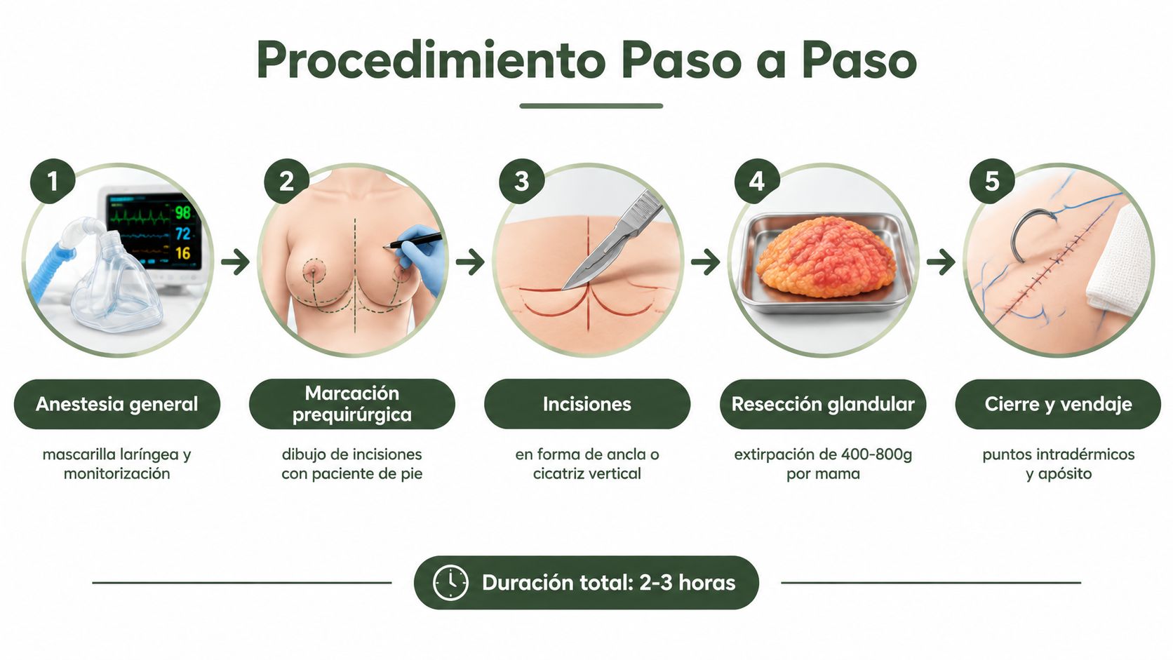 Diagrama paso a paso que ilustra el procedimiento quirúrgico de una reducción de pecho y su duración estimada.