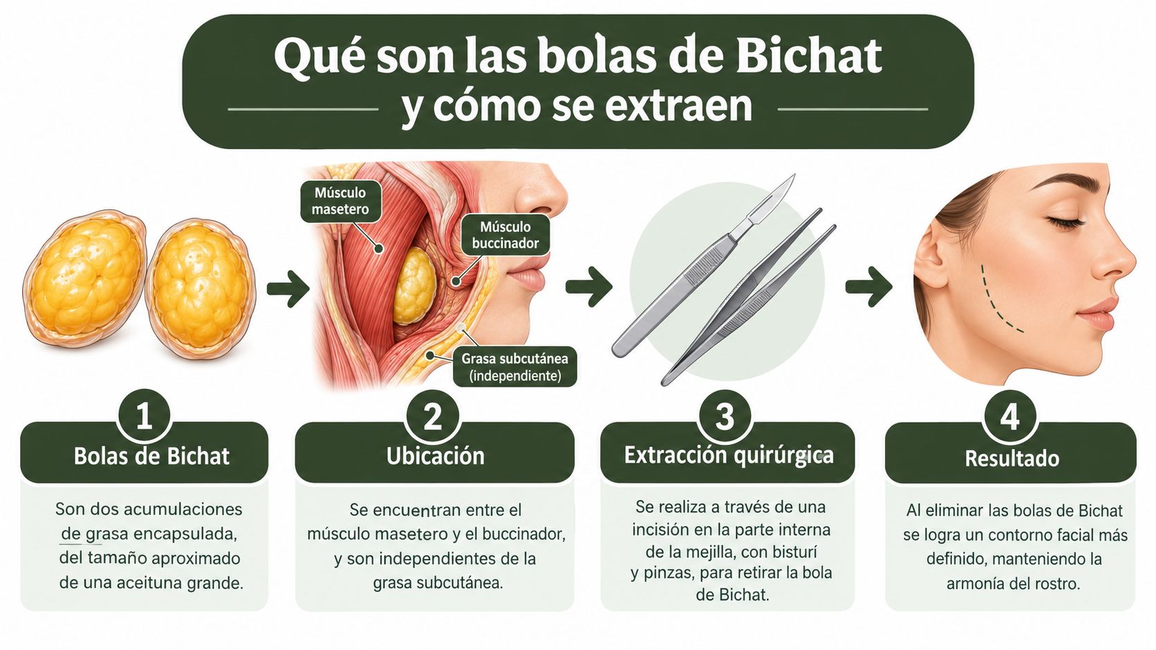 Infografía que explica qué son las bolas de Bichat, su ubicación anatómica y el proceso de extracción quirúrgica.