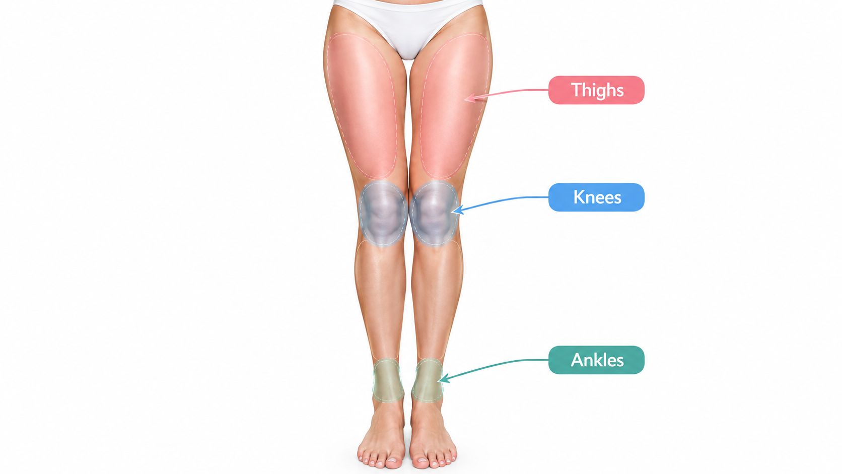 Representación visual de las zonas de las piernas donde se puede realizar una cirugía de lipoescultura.