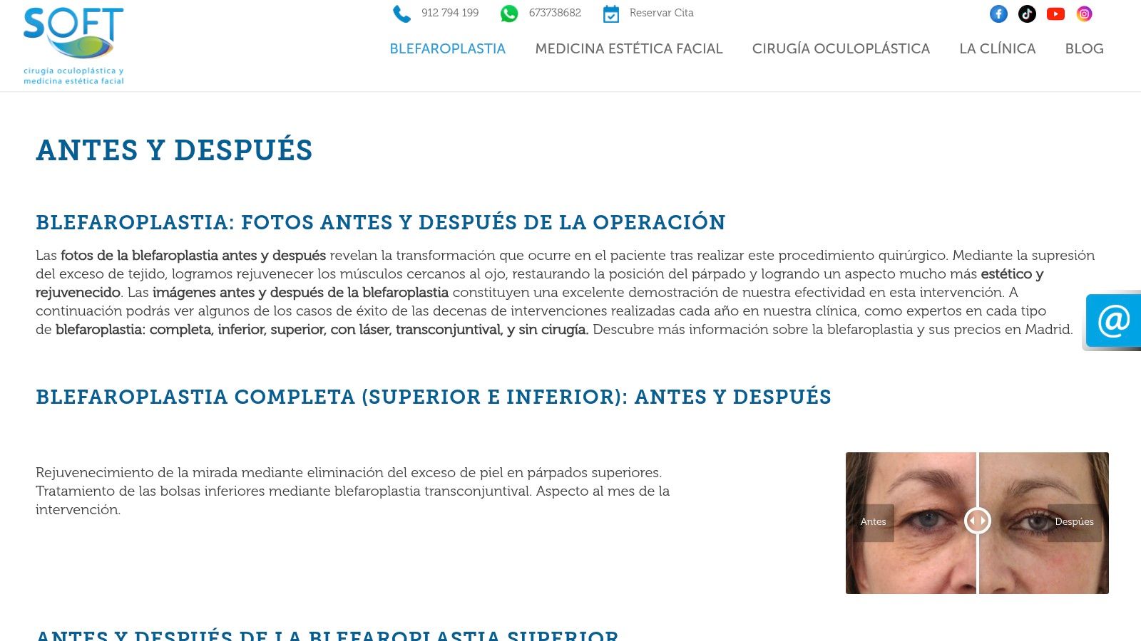 Clínica Soft, Cirugía Oculoplástica (Madrid)