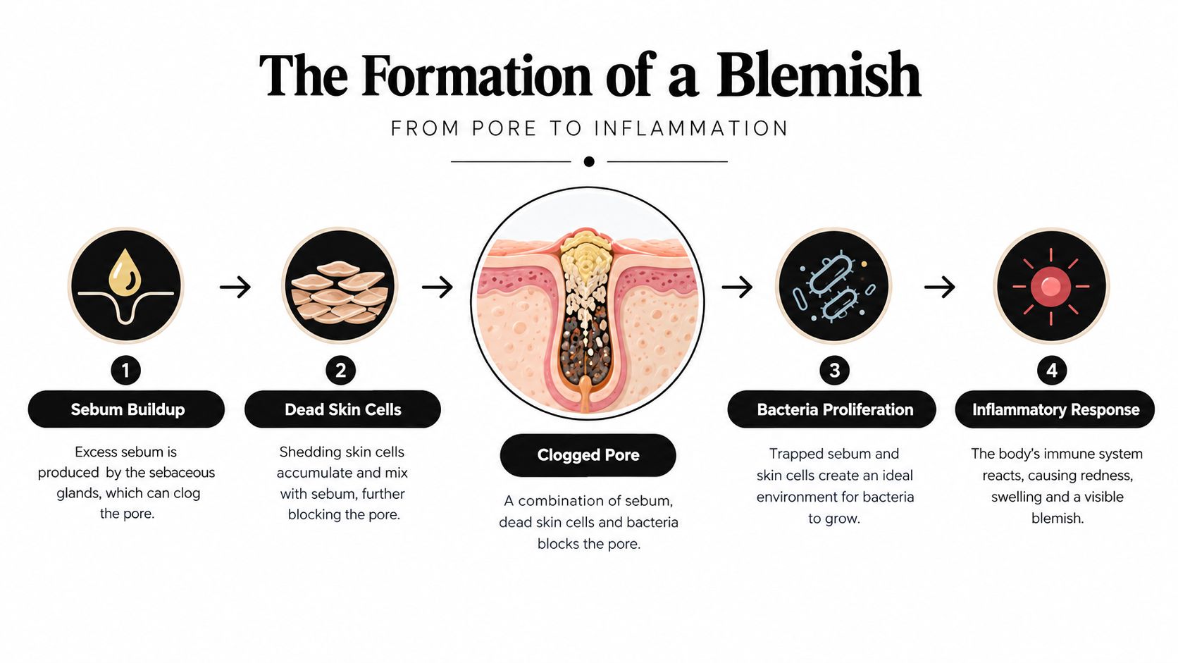 An educational infographic illustrating the four stages of blemish formation from sebum buildup to inflammatory response.