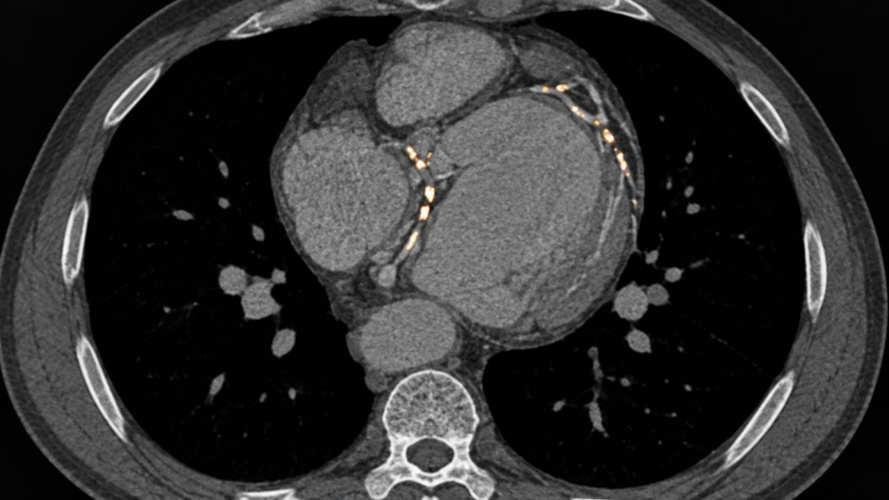Axial CT scan of a human heart showing significant coronary artery calcification highlighted in orange.