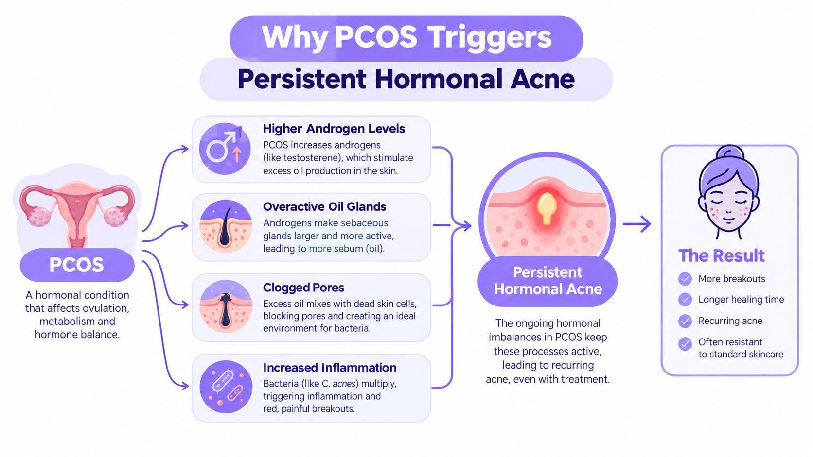 A diagram explaining how PCOS triggers persistent hormonal acne through hormonal imbalance, inflammation, and skin pore blockages.