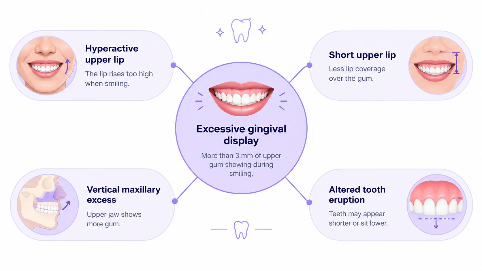 An infographic showing four common causes of excessive gingival display, known as a gummy smile.