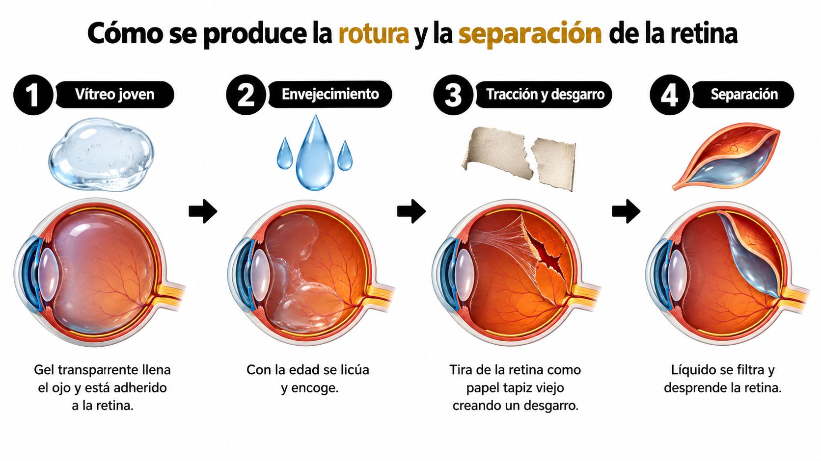 Diagrama médico que muestra las cuatro etapas del proceso de desprendimiento de retina regmatógeno en el ojo.