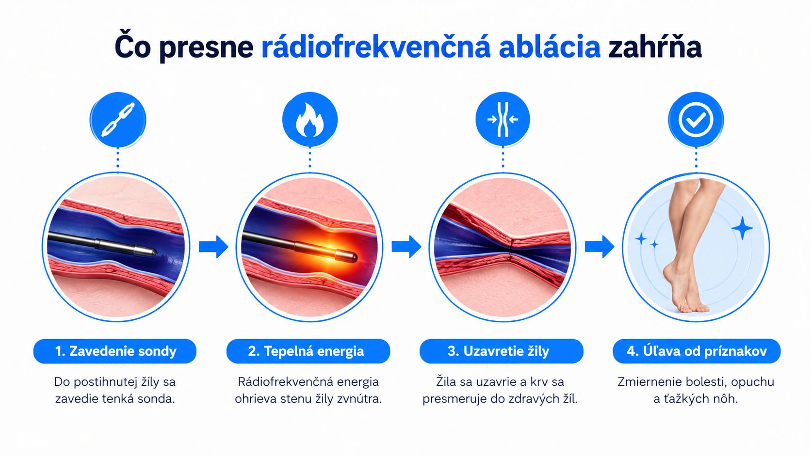 Informačná grafika vysvetľujúca štyri kroky procesu rádiofrekvenčnej ablácie na liečbu kŕčových žíl dolných končatín.