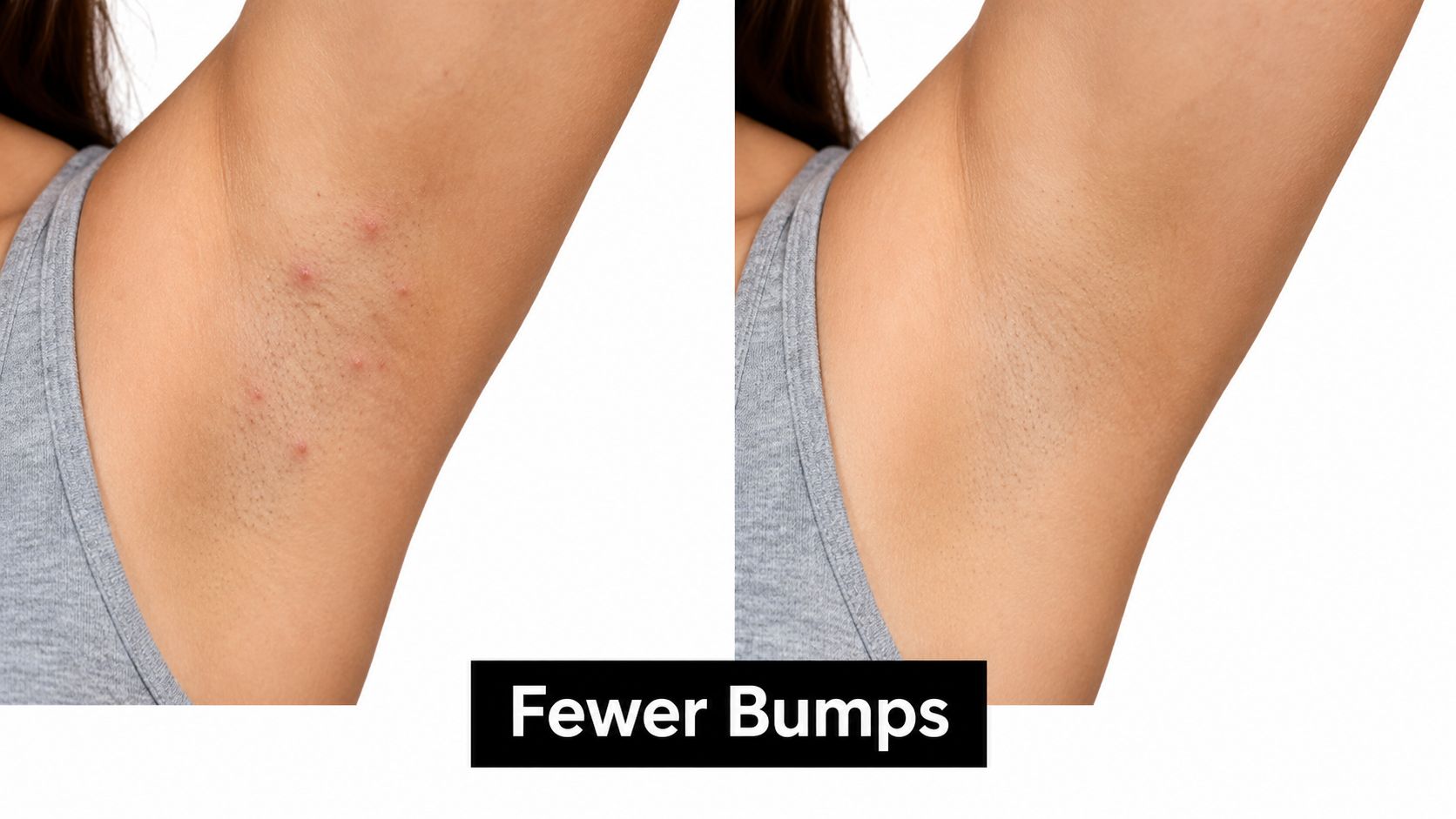 A comparative view of underarm skin showing a reduction in bumps and irritation after treatment.