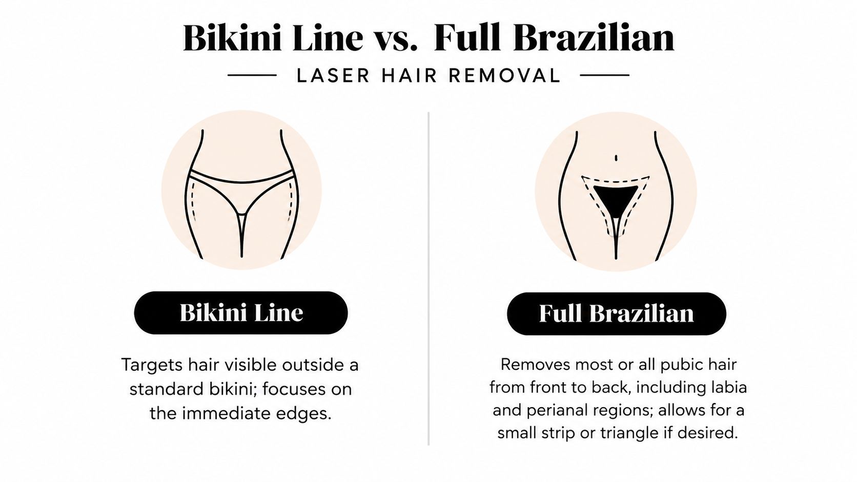 A diagram comparing the coverage areas for bikini line versus full Brazilian laser hair removal treatments.