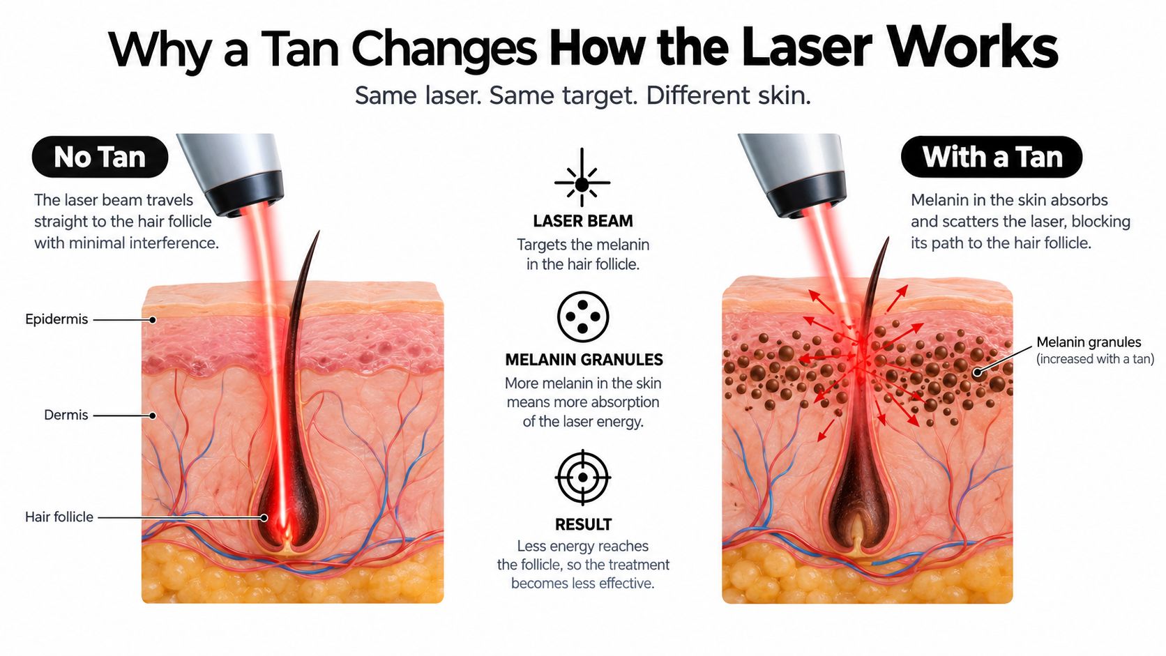 A diagram comparing laser hair removal efficacy on untanned skin versus tanned skin with increased melanin granules.