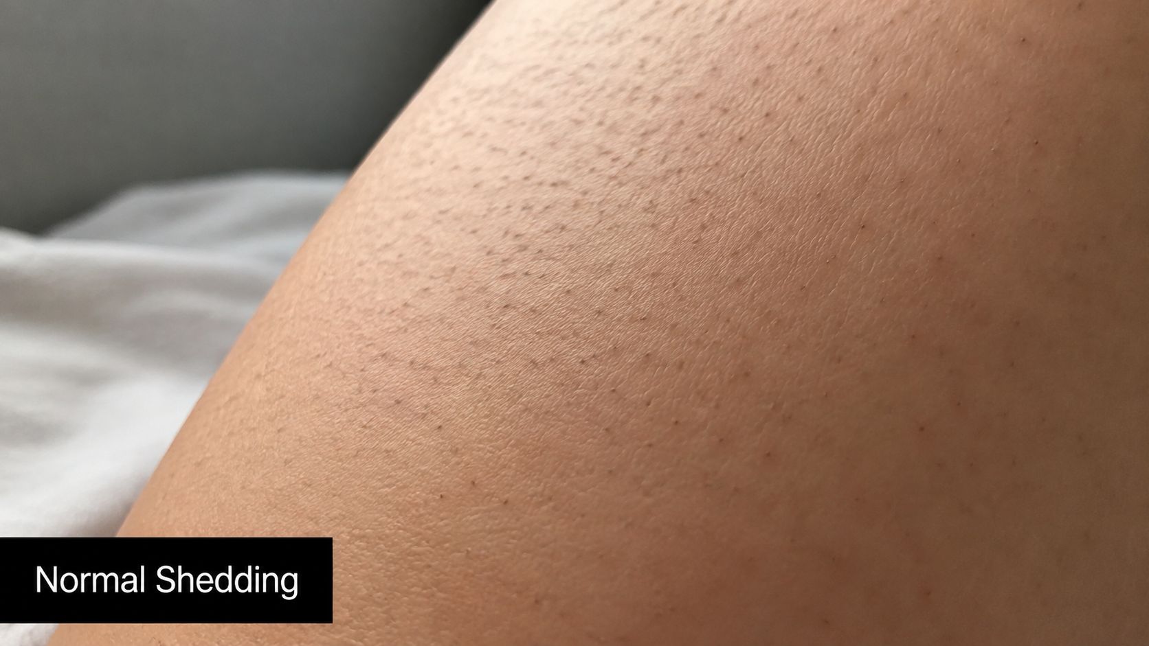 Close-up of skin texture on a leg following Brazilian laser hair removal treatment showing normal healing.