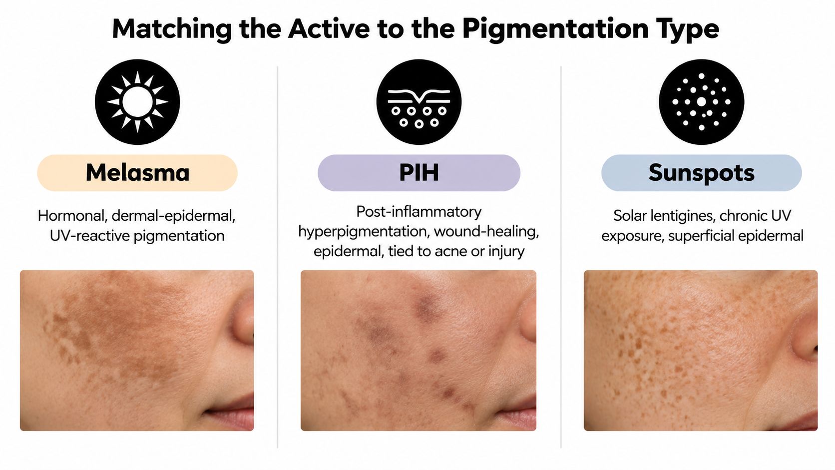 A diagram illustrating and comparing the appearances and causes of melasma, post-inflammatory hyperpigmentation, and sunspots on skin.